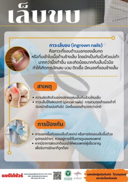 เล็บขบ