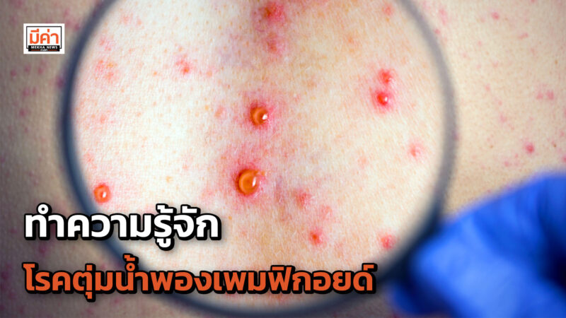 ทำความรู้จัก โรคตุ่มน้ำพองเพมฟิกอยด์ ทำความรู้จัก โรคตุ่มน้ำพองเพมฟิกอยด์