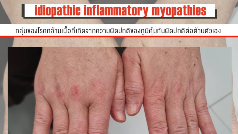 idiopathic inflammatory myopathies