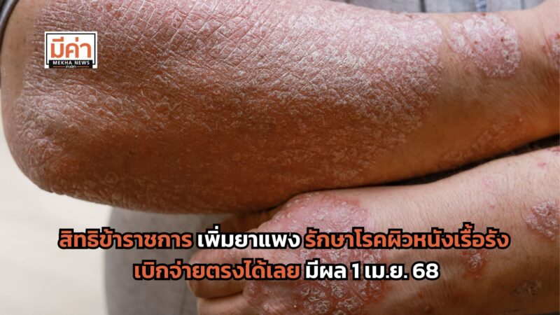 สิทธิข้าราชการ เพิ่มยาแพง รักษาโรคสะเก็ดเงิน โรคเพมฟิกัส โรคผื่นภูมิแพ้ผิวหนัง และ กลุ่มโรครูมาติก ให้เบิกจ่ายตรงได้เลย มีผล 1 เม.ย. 68