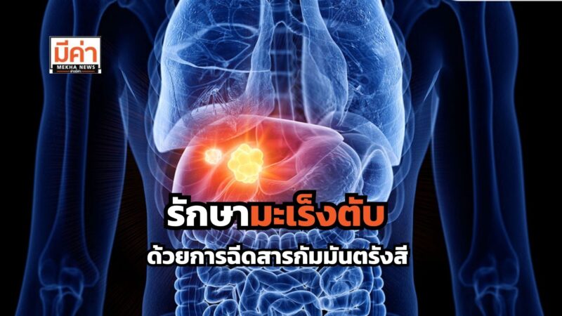 รักษามะเร็งตับ ด้วยวิธีการฉีดสารกัมมันตรังสีผ่านหลอดเลือดแดง