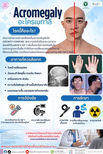 โรงพยาบาลราชวิถี กรมการแพทย์ เผย โรค Acromegaly (อะโครเมกาลี) เป็นโรคที่เกิดจากร่างกายผลิตฮอร์โมนการเจริญเติบโต (Growth Hormone: GH) มากเกินไปในวัยผู้ใหญ่ 