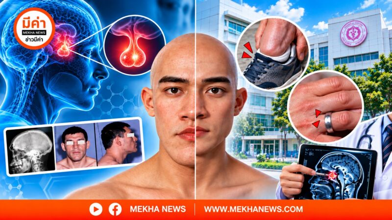 กราฟิกเตือนภัยโรค Acromegaly จากโรงพยาบาลราชวิถี แสดงอาการมือเท้าขยายใหญ่และหน้าเปลี่ยนจากฮอร์โมนการเจริญเติบโตสูงเกิน